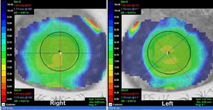 Text Box:    Fig 1. Corneal Topography Plots(Placido):  