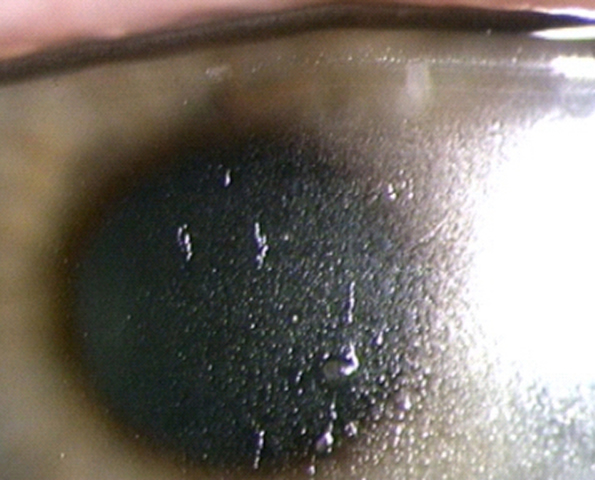 Editorial - Protein And Lipid Deposition Of Silicone-Hydrogel Contact Lens  Materials